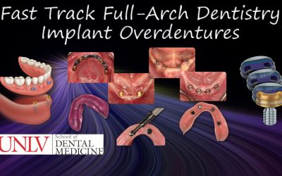 Fast Track Full-Arch Dentistry Implant Overdentures